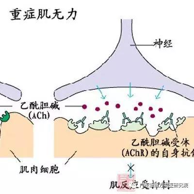 兒童重症肌無力早診斷早治療早受益